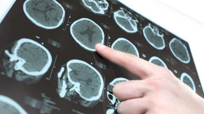 Ilaçi që ngadalëson zhvillimin e sëmundjes së Parkinsonit