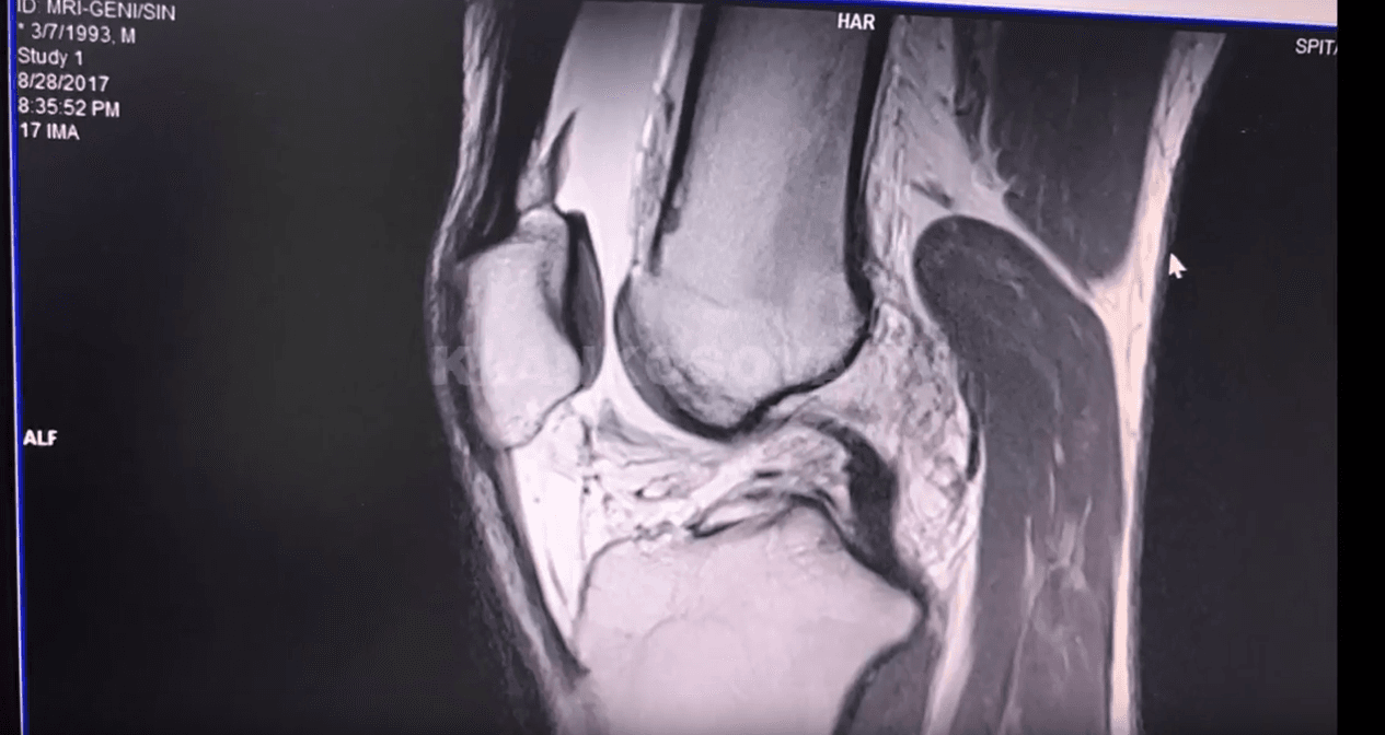 Këput ligamentet dhe shqyen meniskët, por prapë ëndërron olimpiadën (VIDEO)