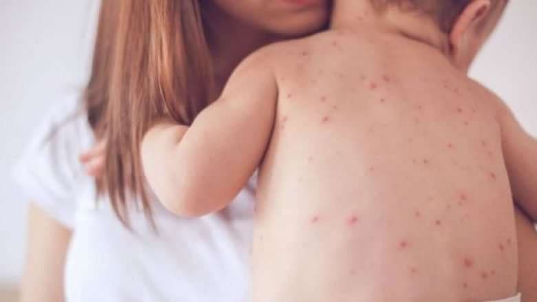 Vdes fëmija në QKUK, familja thotë se ndërroi jetë nga fruthi
