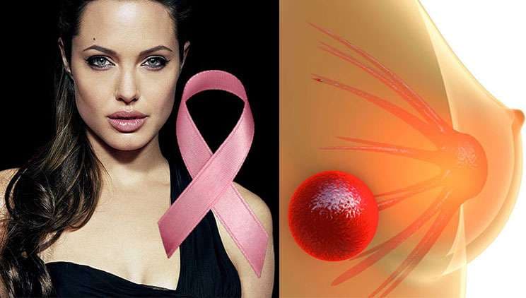 Kirurgja e Angelina Jolie, rekomandon sojën kundër kancerit të gjirit