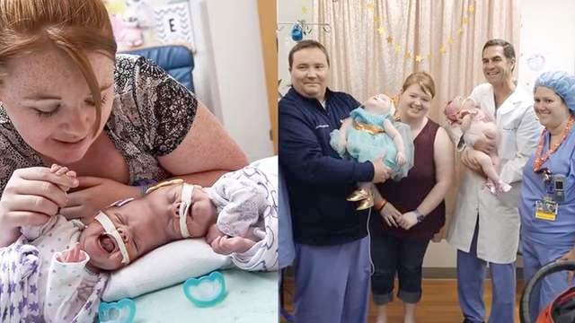 Ndahen me operacion kirurgjik binjakët që lindën të ngjitur në kokë (VIDEO)