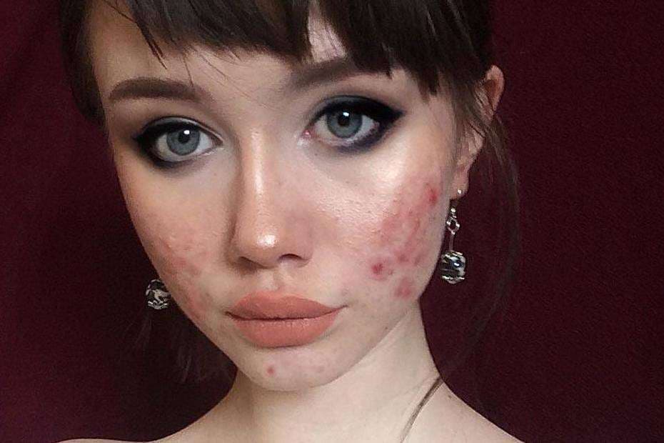 ‘Modelja’ e Instagramit që nuk i fsheh aknet
