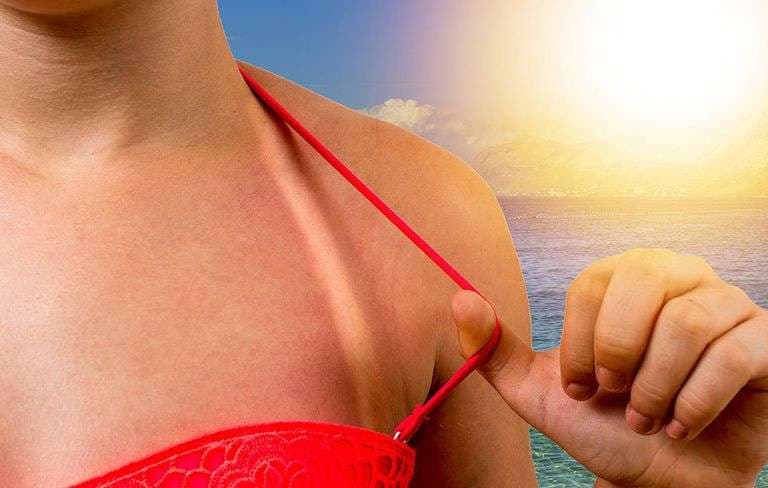 Mënyra praktike për të shëruar djegien nga dielli