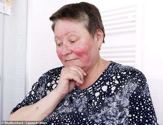 Kafja është e mirë për lëkurën, ul rrezikun për rosacea