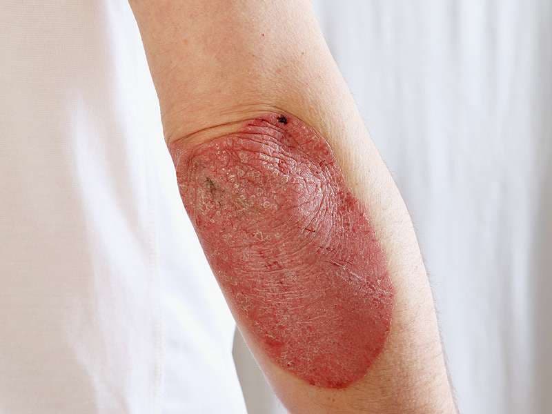 Çfarë është psoriaza?