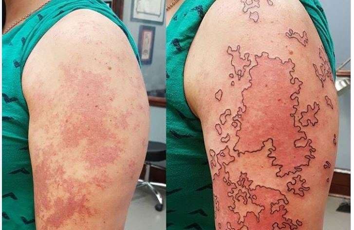 Tatuazhet zbukurojnë shenjat e padëshiruara në trup (FOTO)