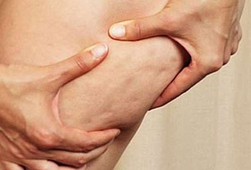 Këto janë ushqimet kundër celulitit