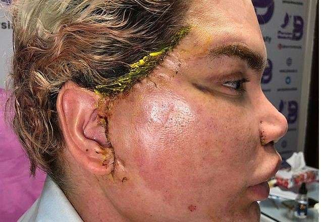 200 fije penj në fytyrë i ka nga operacioni pesë orësh, “Njeriu Ken Doll”