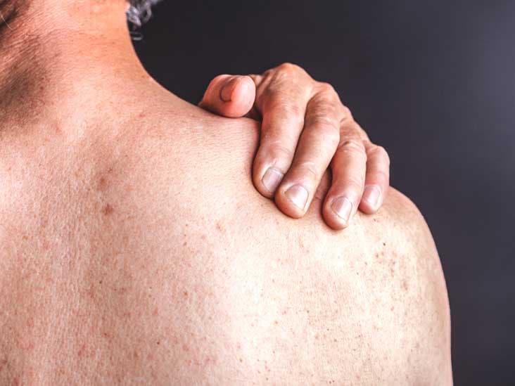 Gjashtë gjërat që mund të shkaktojnë psoriazën – sëmundjen e lëkurës