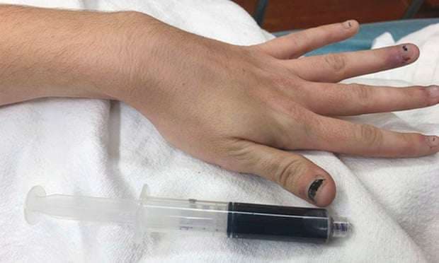 Ilaçi për mpirje ia bëri gjakun e kaltër
