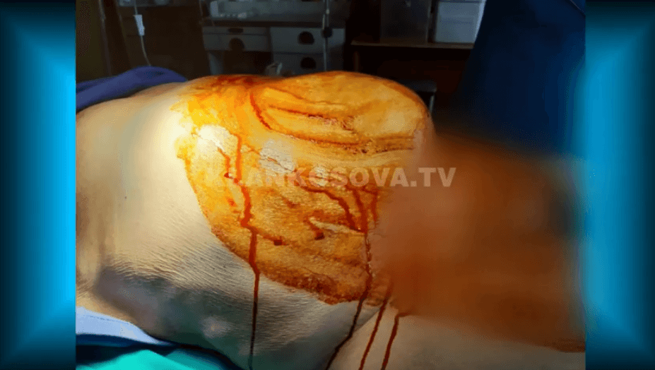 Në QKUK kryhet një operacion që është kryer vetëm 13 herë në botë (VIDEO)