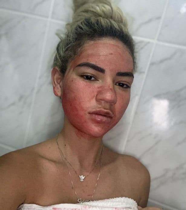 Influencerja përdorë gjakun e menstruacioneve për trajtimin e fytyrës