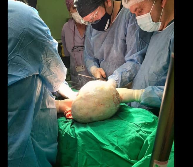 Mjekët në Spitalin e Mitrovicës i heqin një pacientit tumorin me peshë 15 kilogramë
