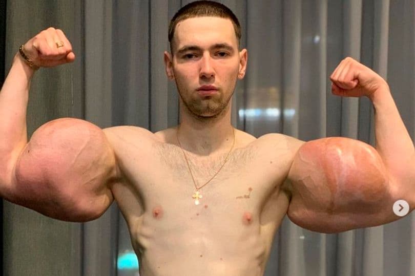 "Popeye", bodibillderi që bëri muskuj fals mund t`i humbasë krahët