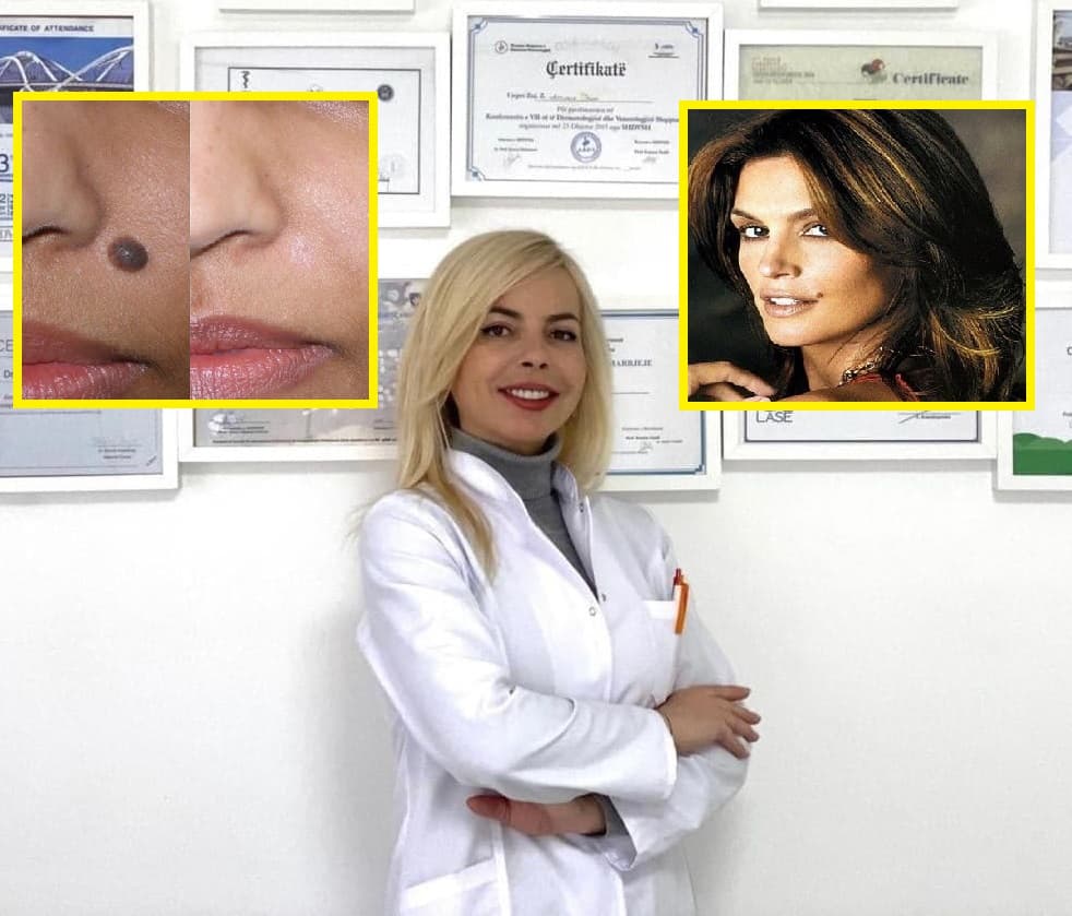 Doni t’i hiqni nishanet? Ja ç’thotë mjekja e lëkurës!