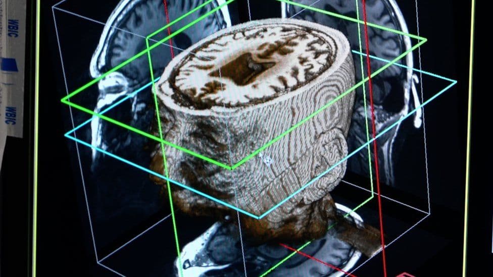 Inteligjenca artificiale mund të diagnostikojë demencën brenda një dite