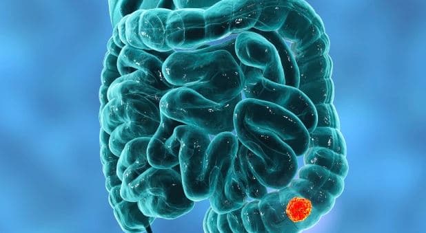 Diagnostikimet e kancerit të zorrëve ranë 40 përqind gjatë pandemisë, zbulon studimi i ri