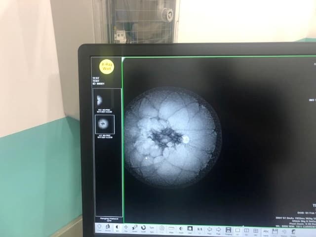 Spitali i Ferizajt bëhet për herë të parë me Mamograf