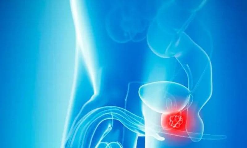 Këto janë simptomat e para të kancerit të prostatës