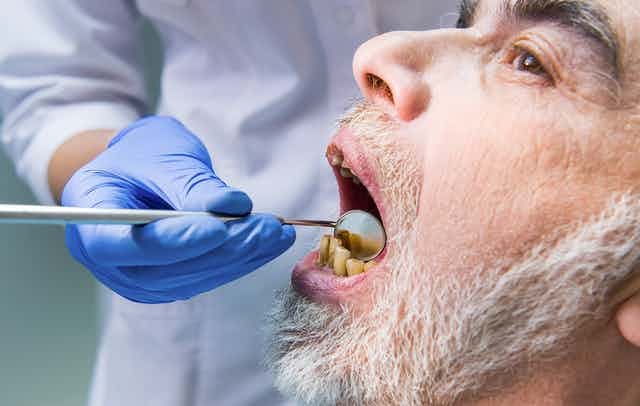Shëndeti i dobët oral mund të rrisë rrezikun e COVID-19