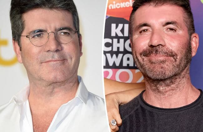 Simon Cowell heq dorë nga injektimet në fytyrë