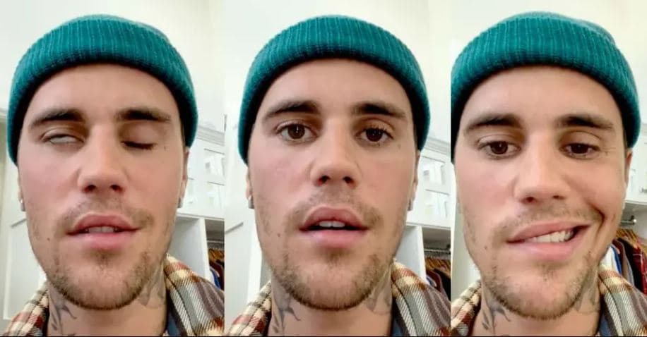 Çka është sindroma Ramsay Hunt, virusi nga i cili po vuan Justin Bieber?
