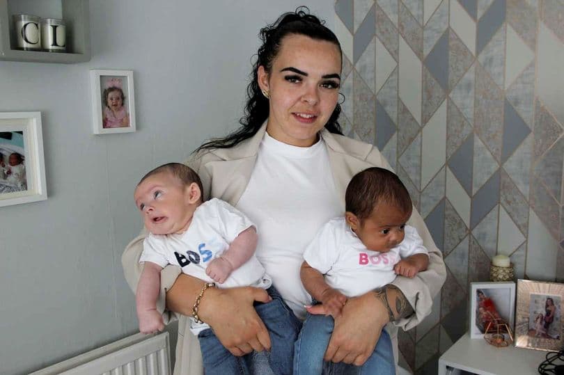 Gruaja lind binjakë me ngjyra të ndryshme të lëkurës