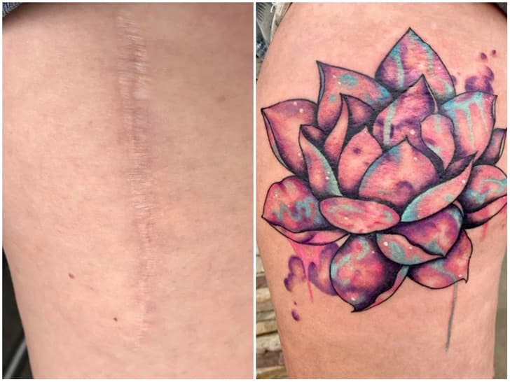 Persona që përdorën artin e tatuazheve për t’i mbuluar shenjat e plagëve (FOTO)