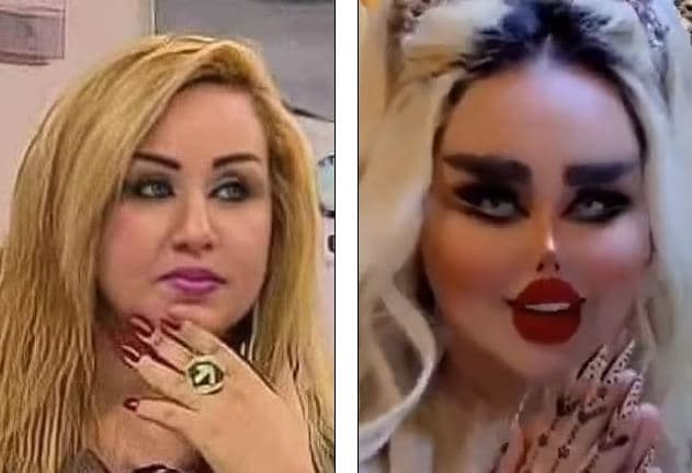 Irakiania iu nënshtrua 43 ndërhyrjeve estetike për t'u dukur si "Barbie" (FOTO)
