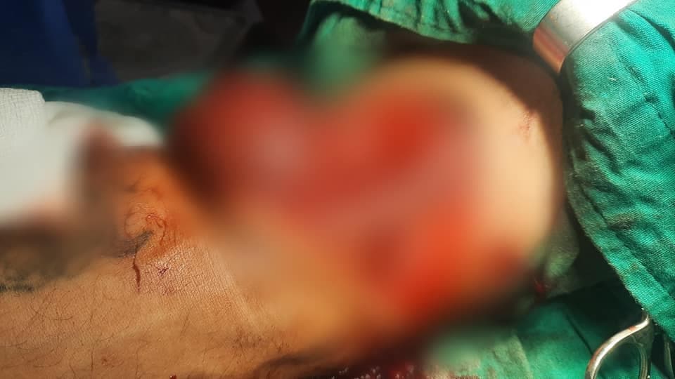 E preu gati krejt krahun e djathtë me xham, në QKUK kryhet me sukses operimi i 36-vjeçarit (VIDEO)