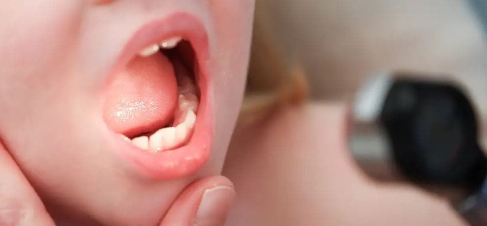 Rritet rezistenca ndaj antibiotikëve tek fëmijët