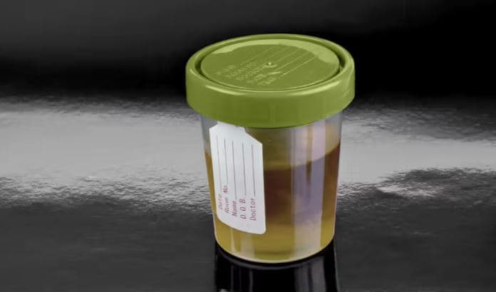 Testi i ri i urinës mund të zbulojë herët kancerin ovarian