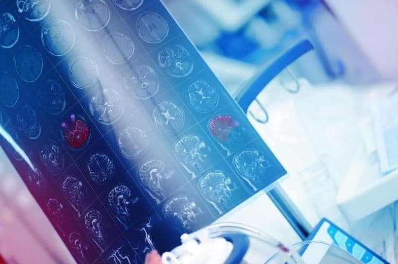 Pajisja me ultratinguj e implantuar në kafkë mund të ndihmojë në shenjëstrimin e tumoreve të trurit
