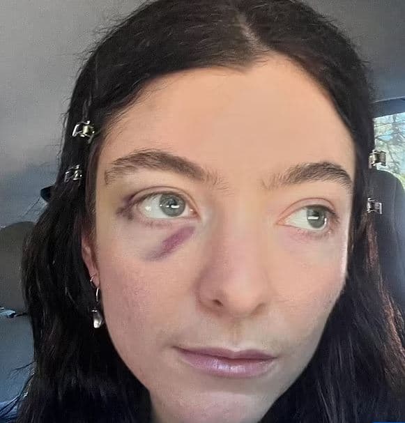 Lorde publikon foto me sy të mavijosur