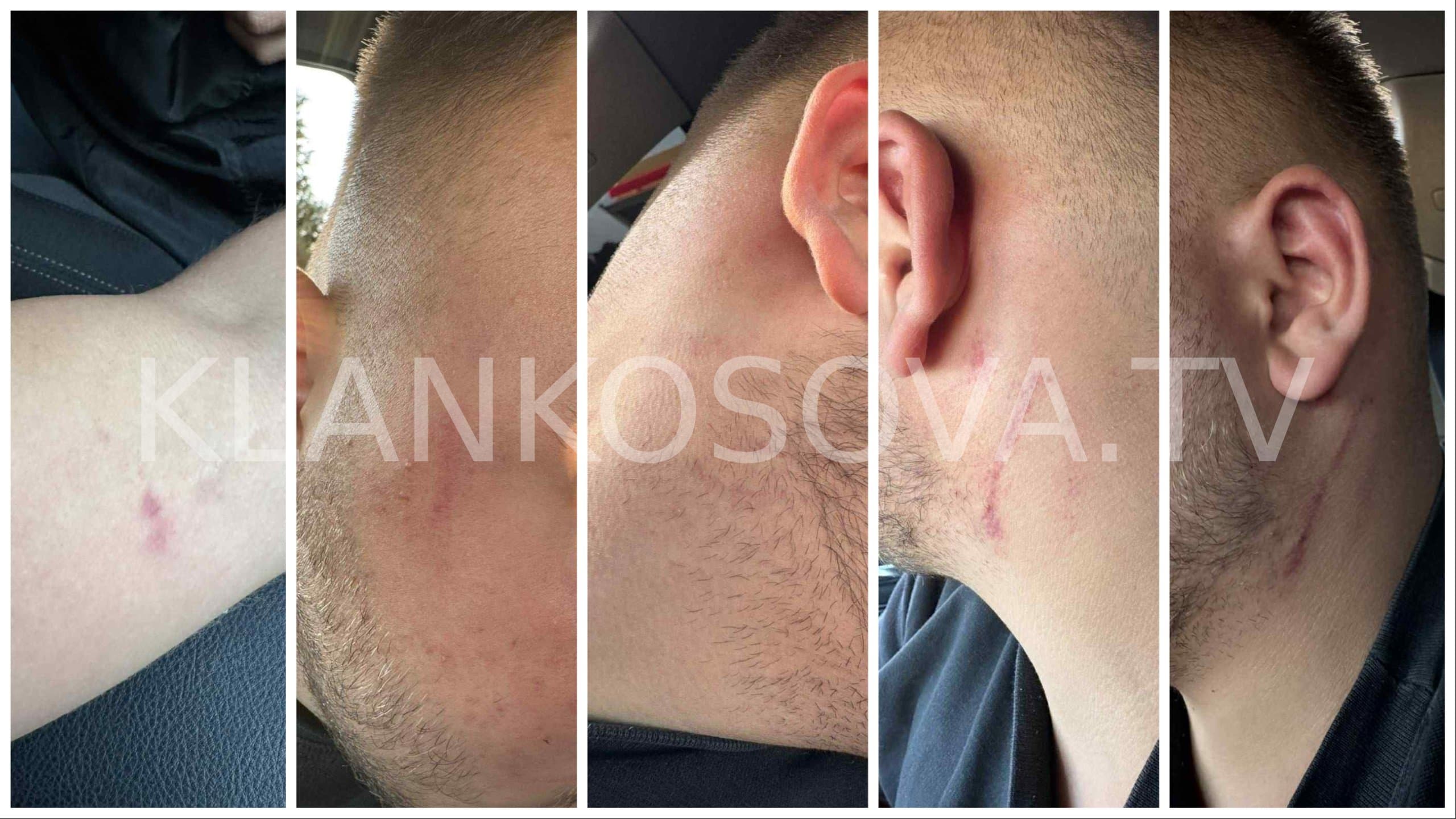 Katër policë dyshohet se rrahën 2 vëllezër që bënë gara makinash në Prishtinë (FOTO/VIDEO)