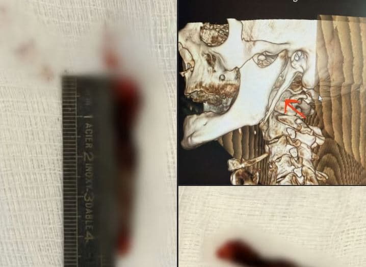 Për herë të parë në Kosovë kryhet me sukses operacioni për Sindromën Eagle