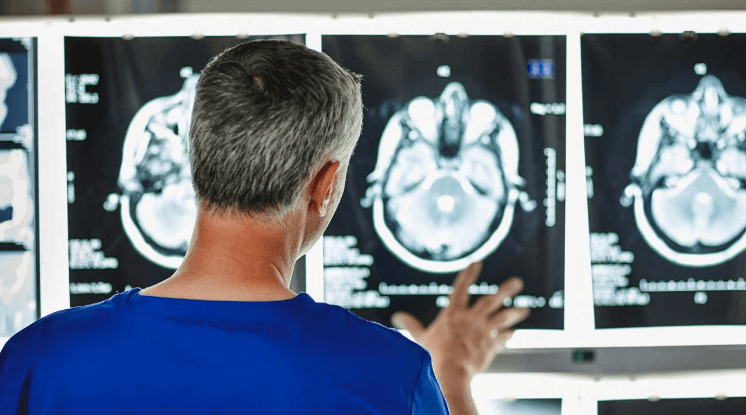 Hekuri i tepërt në tru, shkaktar potencial i Alzheimerit