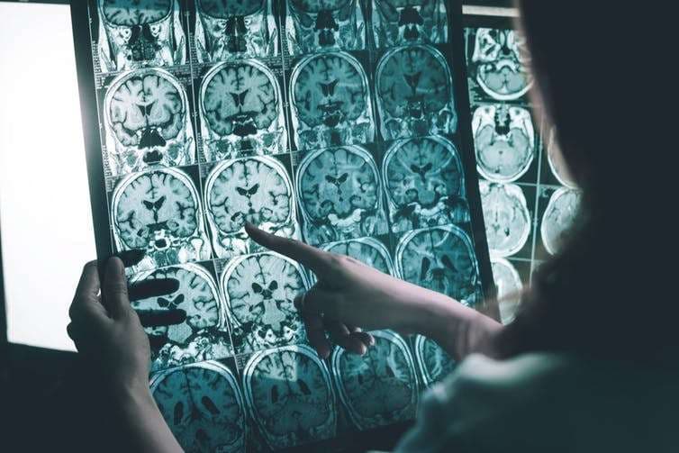 Herpesi mund të zhvillojë sëmundjen e Alzheimer