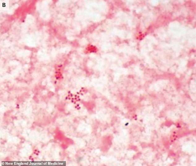 Gonorrea prek në vit 78 milionë njerëz në mbarë botën, thotë OBSH