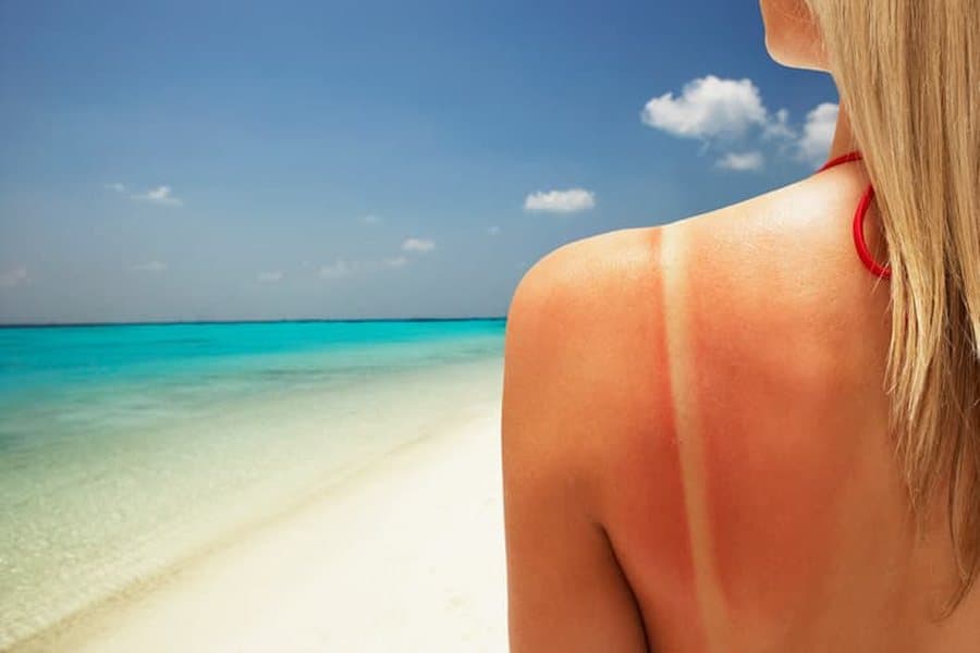 Kujdesi dermatologjik në verë: Si të mbrojmë lëkurën nga dëmtimet e diellit?